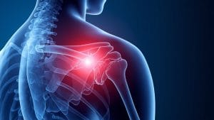 Rare Shoulder Condition Highlighted in Leading Medical Journal